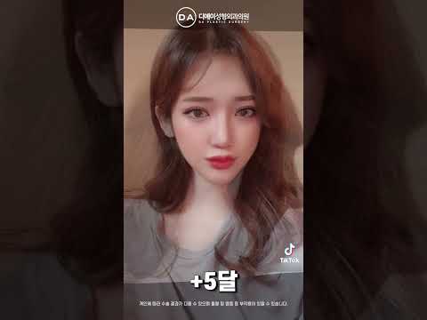 미니리프팅+뒤트임+밑트임+윗트임
