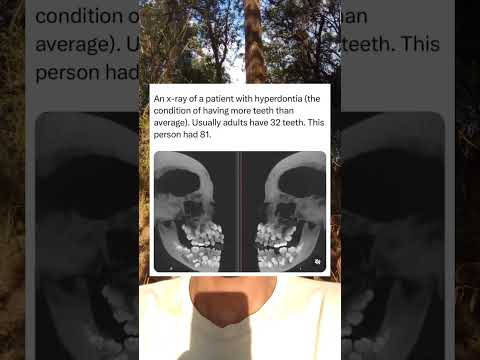 Hyperdontia is a condition where you have more teeth than average