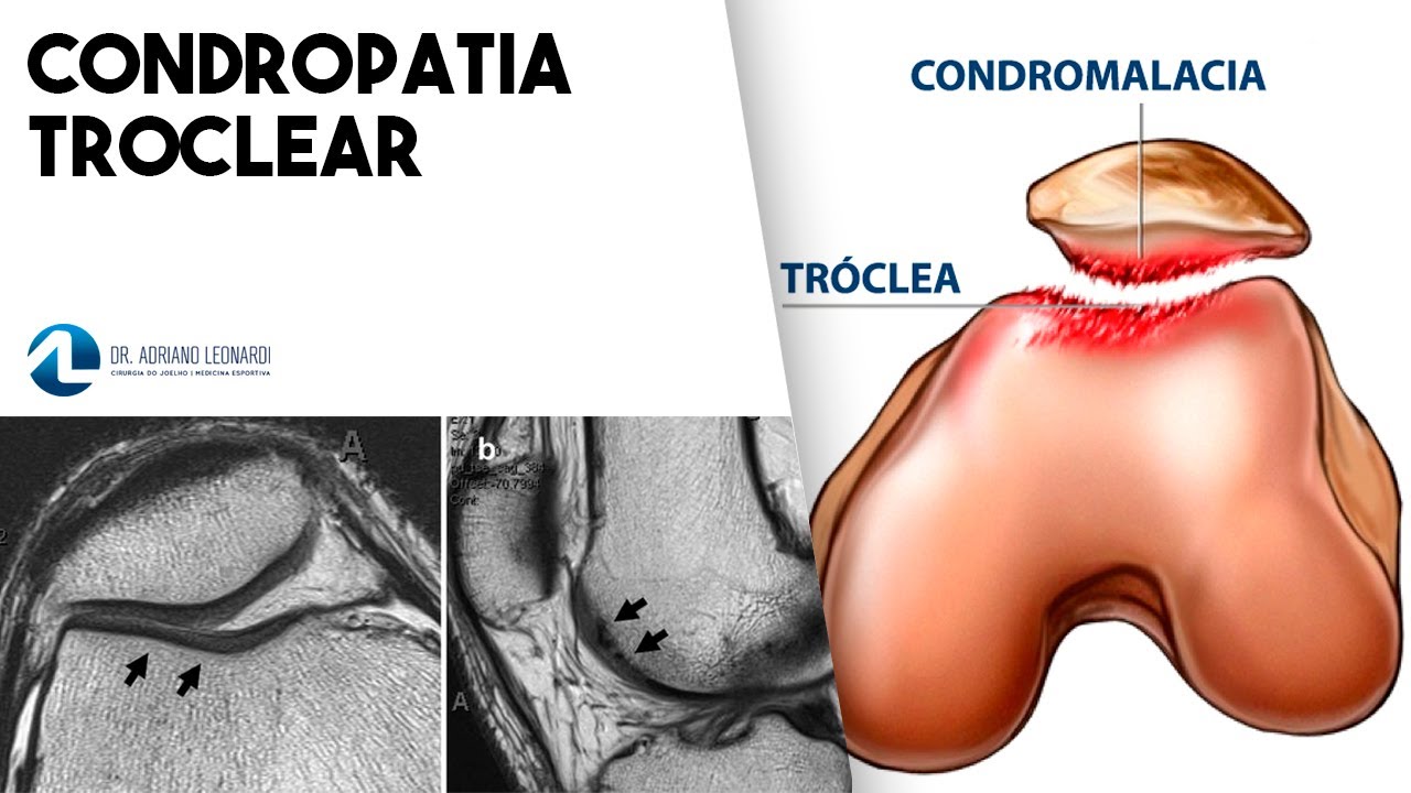 CONDROPATIA TROCLEAR: o que é, diagnósticos, sintomas e tratamento
