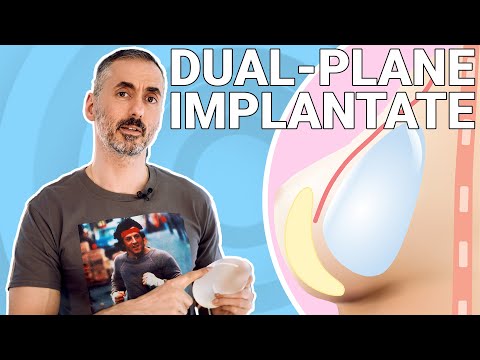 Dein Plastic Surgery Coach – Bruststraffung vs. Dual Plane Layer Technik