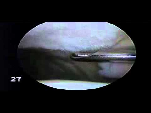 Il trattamento conservativo dellosteoartrite del ginocchio Esercizi per le articolazioni delle gambe immagini