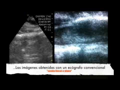 Intramedullary Lump Examination During Surgery By Pocket-Sized Ultrasound