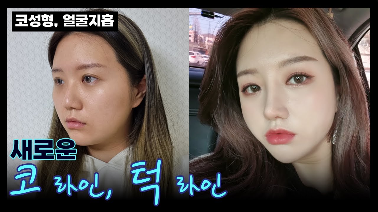 [브이로그]  이제 보정은 안녕? ?코성형 + 얼굴지흡?
