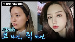 [브이로그]  이제 보정은 안녕? ?코성형 + 얼굴지흡?