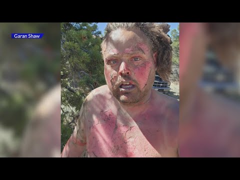 Colorado man shares warning after suffering severe burns in mechanical accident