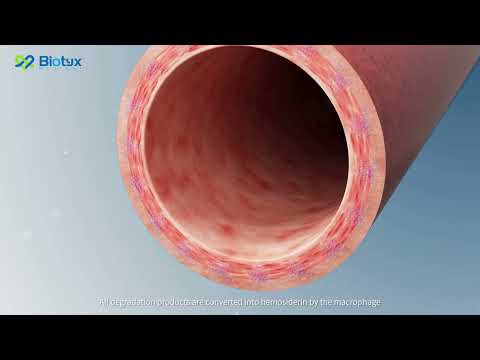 Degradation Mechanism Of IBS Iron Based Bioresorbable Scaffold