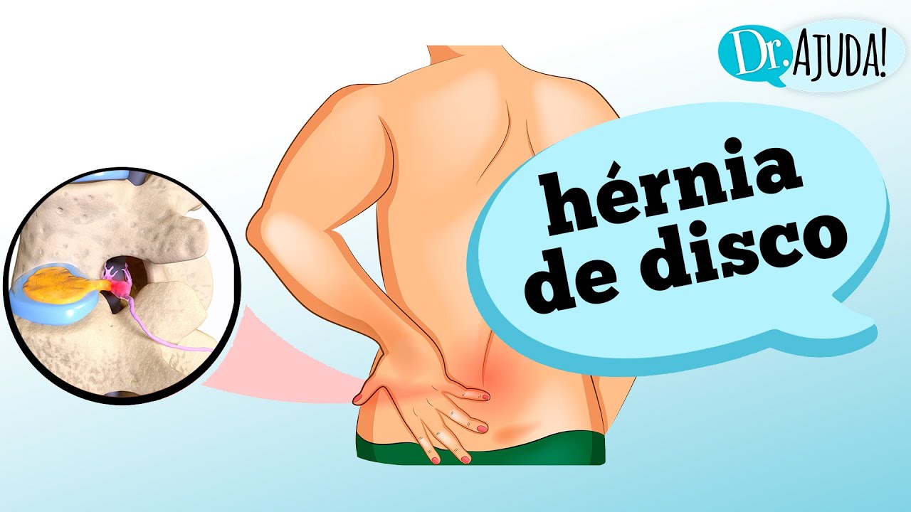 O que é a HÉRNIA DE DISCO? Entenda como ocorre e seus sintomas!
