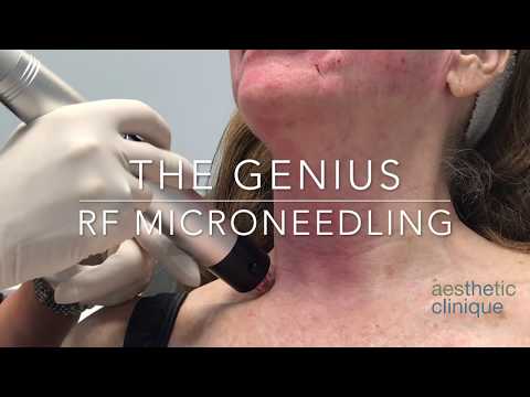 RF Microneedling Genius System - Re-engineered Infini
