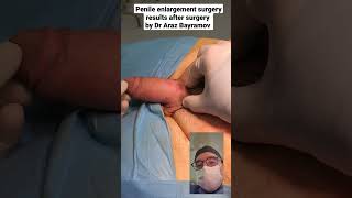 Download lagu Penile enlargement surgery results after surgery by Dr Araz Bayramov #andrologist #penis mp3 Download lagu Penile enlargement surgery results after surgery by Dr Araz Bayramov #andrologist #penis mp3