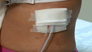 How to care for a post-surgery wound drainage system and gauze dressing
