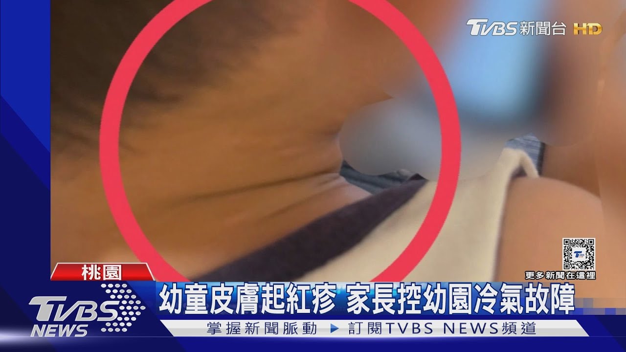 幼童皮膚起紅疹 家長控幼園冷氣故障
