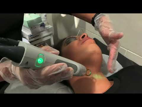 face laser hair removal 1st Session I laser hair removal