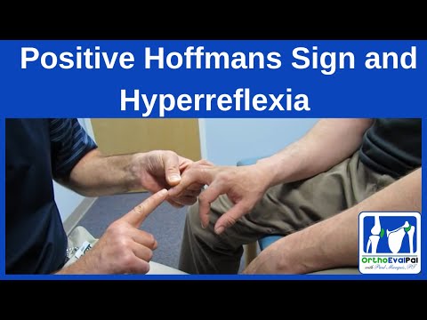 Positive Hoffmans Sign and Hyperreflexia