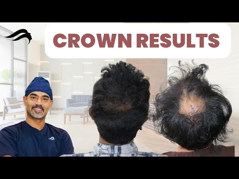 Hair Transplant In Chennai | Best Results Cost &...