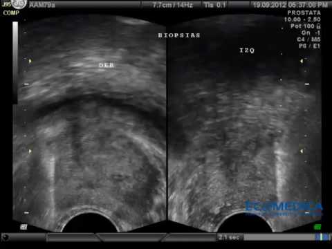 Trattamento della prostata clisteri adenoma Vedi tutte del trattamento della prostata libera