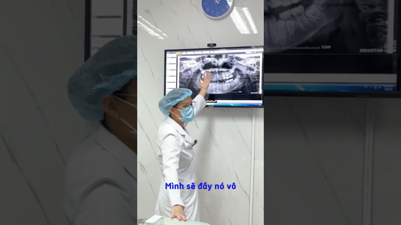 Niềng răng hô có phải nhổ răng không?