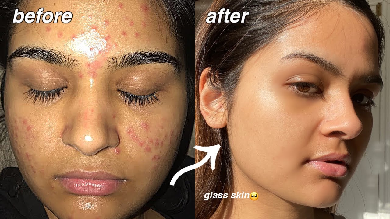 Watch video how i cleared my acne FOR GOOD *something finally worked* Now how i cleared my acne FOR GOOD *something finally worked*