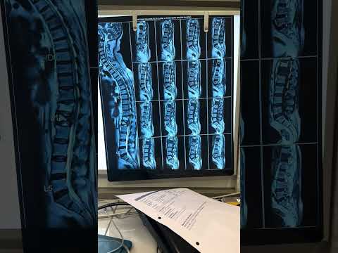 Spine fracture treatment Spine fracture treatment| Dr. Ajay Kothari