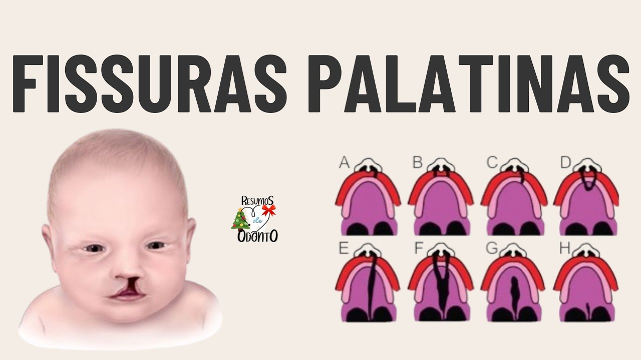 FISSURAS LABIOPALATINAS | RESUMOS DE ODONTO