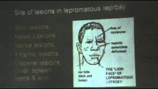 Dr.Sahar - Bacterial Infections 6 - Sarcoidosis - Leprosy