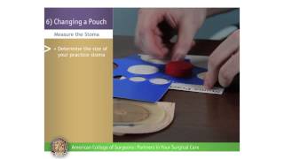 Pediatric Urostomy: Changing a Pouch
