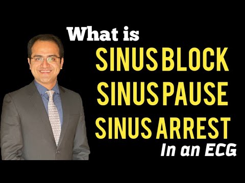 Sinus Arrhythmia, Sinus Block, Sinus Pause, Sinus Arrest ECG, Causes, Treatment, ECG Lectures USMLE