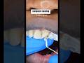 Composite Bonding On Front Tooth Viral Composite Compositebonding Cosmetics Smile Teeth Dentist