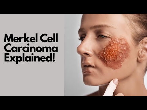 EDUCATIONAL VIDEO | Merkel Cell Carcinoma Wikipedia Audio Article | Skin Cancer Biology Explained!