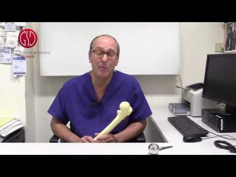 La risposta dell'Esperto - Traumatologia e pronto soccorso: frattura del femore