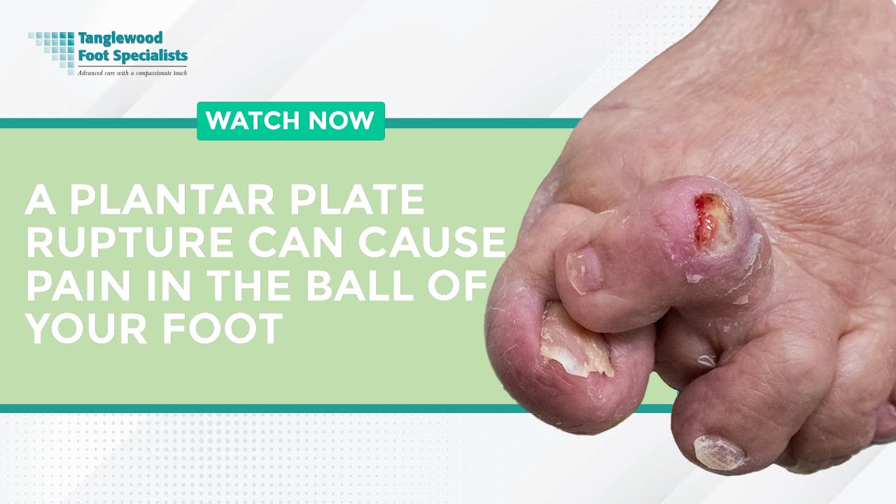 A Plantar Plate Rupture Can Cause Pain in the Ball of Your Foot