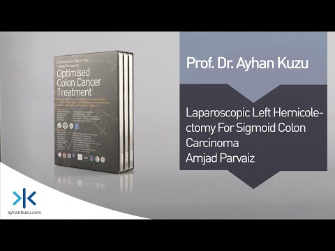 3.1.3. Laparoscopic Left Hemicolectomy for Sigmoid Carcinoma - Amjad Parvaiz