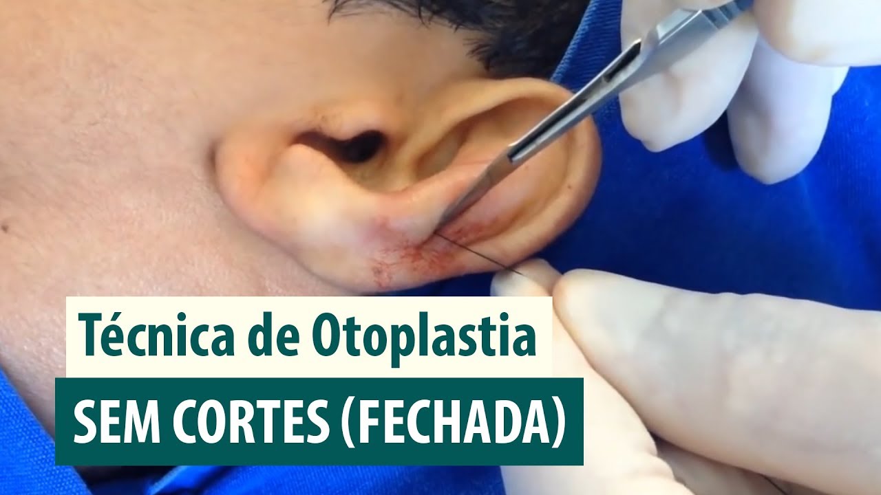 Aula de Técnica de Otoplastia Fechada com Fios e Sem Corte - Dr. Alexandre Marcondes Rezende