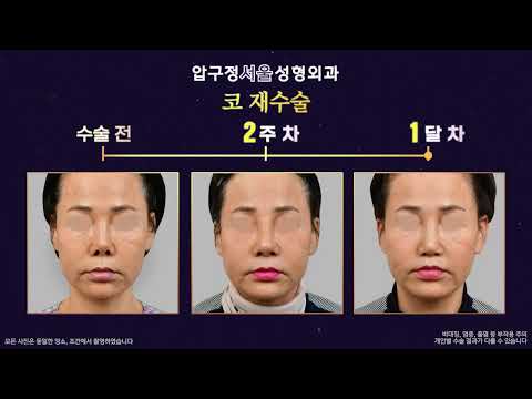 코재수술 1달 경과 비교