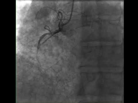 ST Elevation Myocardial Infarction in Angiographically Non-Obstructed Coronary Arteries