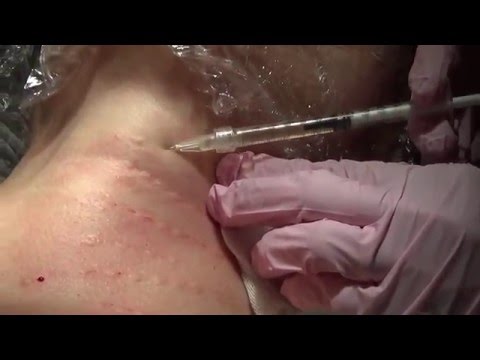 operaiunea varicleoza pe picioare ce injecii sunt din varicoza