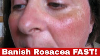 No More Red! How to Get Rid of Rosacea Effectively!