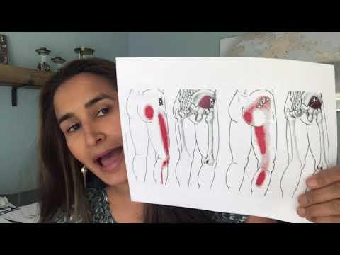 download lagu mp3 mp4 Trigger Point Patterns, download lagu Trigger Point Patterns gratis, unduh video klip Trigger Point Patterns