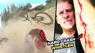 HARD CRASH ON MY DOWNHILL BIKE IN WHISTLER BIKE PARK!