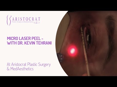 Micro Laser Peel- with Dr. Kevin Tehrani