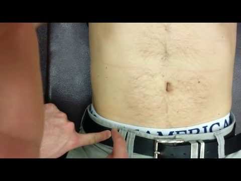 How to find McBurney's Point