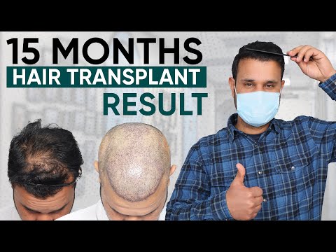 Hair Transplant in Pune | Best Results & Cost