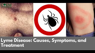 Lyme Disease: What You Need To Know