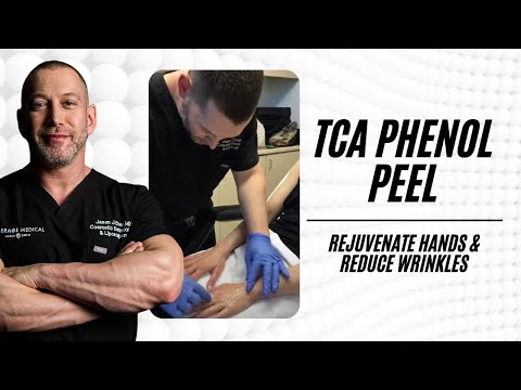 TCA PHENOL CHEMICAL PEEL FOR HAND WRINKLE AND SUN DAMAGE REJUVENATION | DR JASON EMER