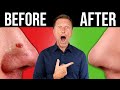 The BEST BLACKHEAD Acne Remedy In The World One Time Fix