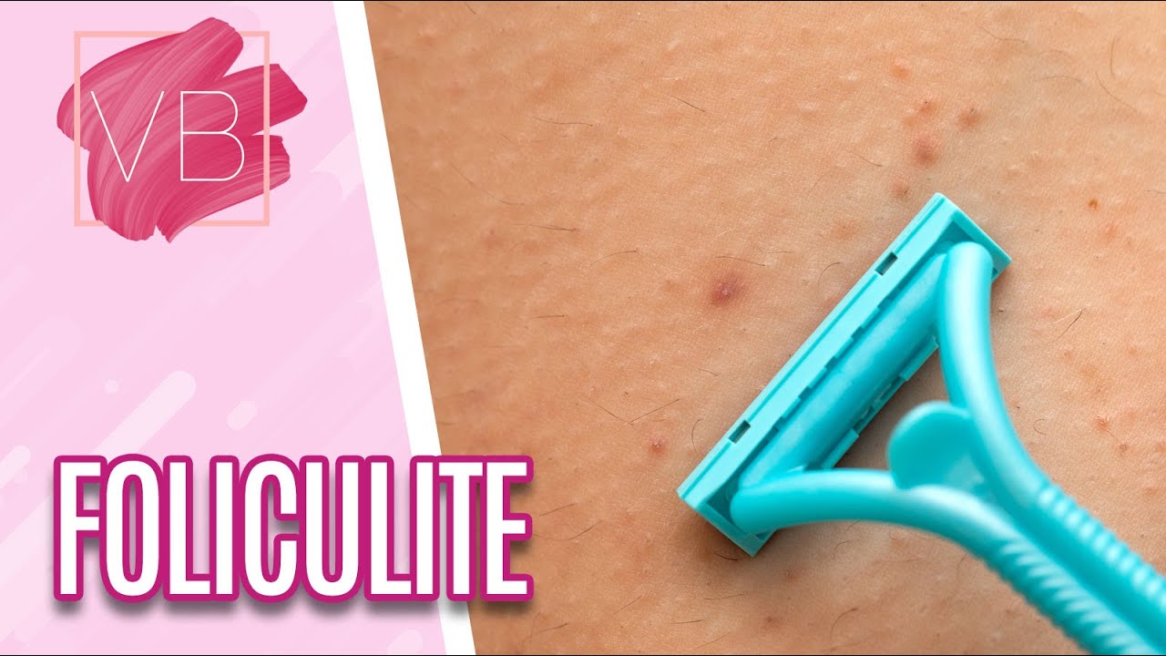 Foliculite: o que é e como tratar corretamente - Você Bonita (25/01/2023)
