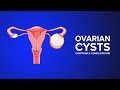 Ovarian Cysts Symptoms And Complications Explained By An OB GYN