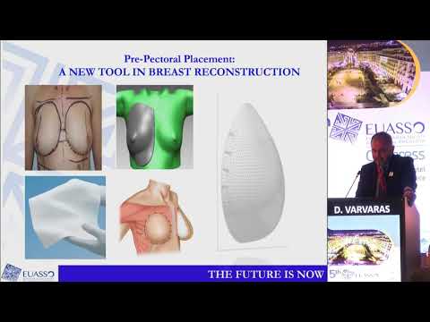 D. Varvaras - Prepectoral implant based breast reconstruction: An evolving paradigm