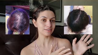 MINOXIDIL Oral e Líquido 8 MESES DE TRATAMENTO | Mariana Oliveira