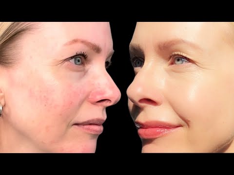 AZELAIC ACID - how to layer in your routine | it FIXED my ROSACEA !!