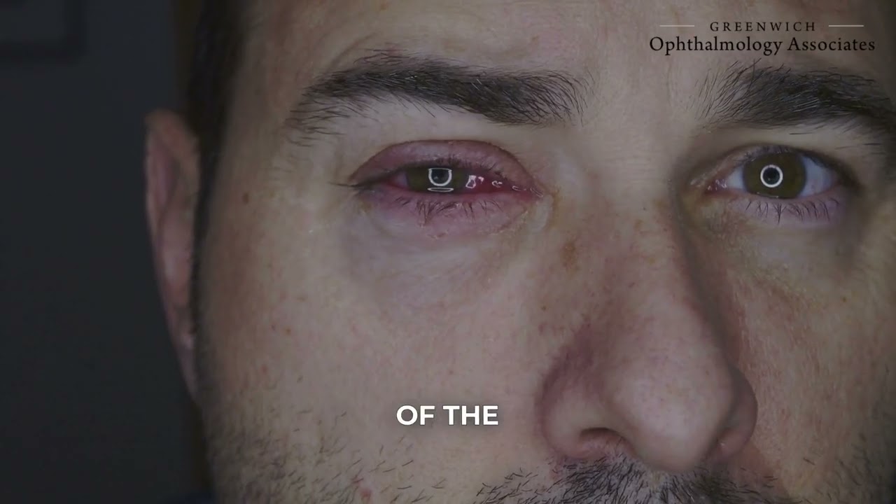 Understanding the Difference Between Allergies and Dry Eye